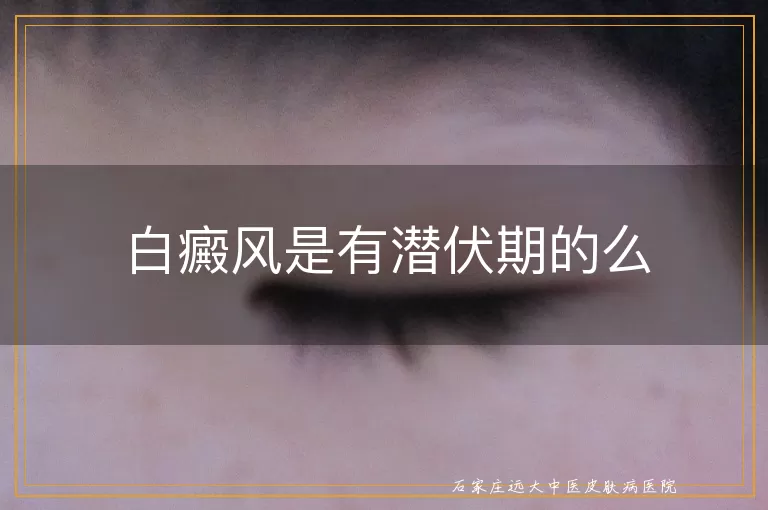 白癜风是有潜伏期的么