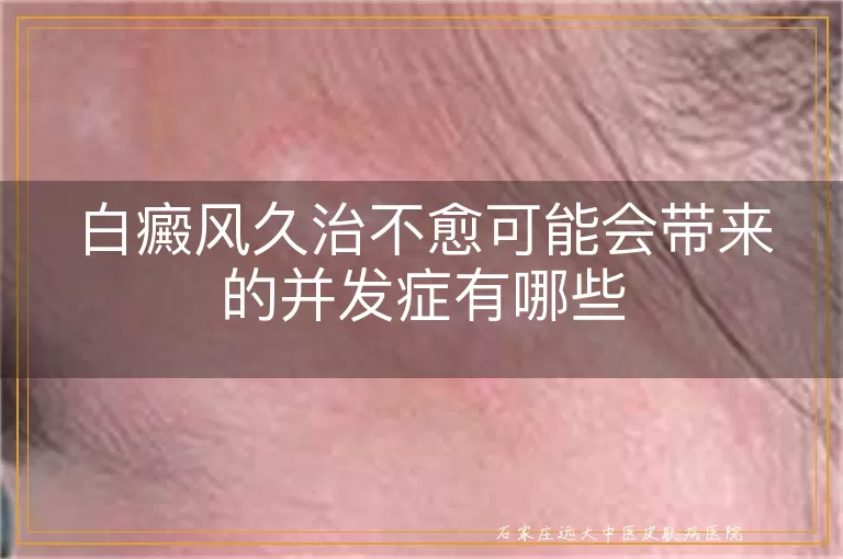 白癜风久治不愈可能会带来的并发症有哪些