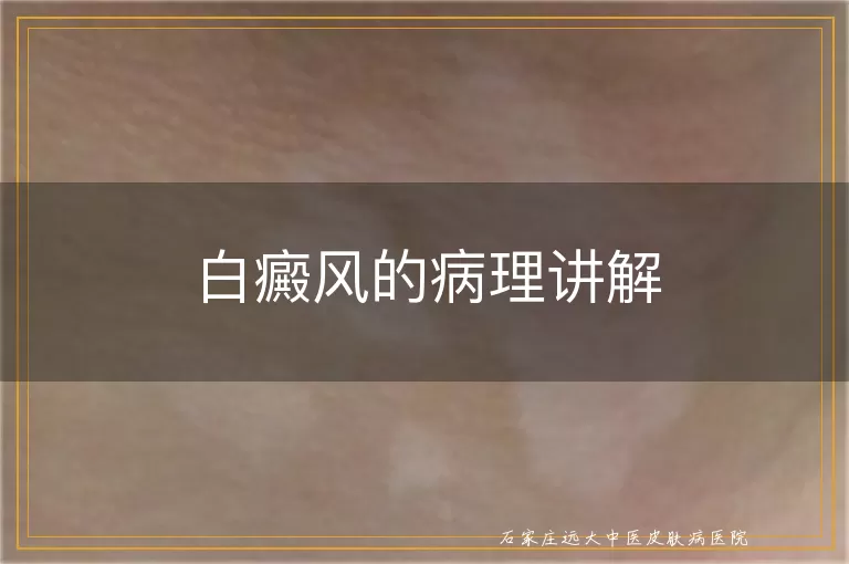 白癜风的病理讲解