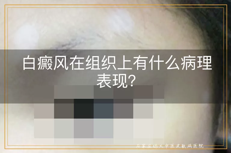 白癜风在组织上有什么病理表现？