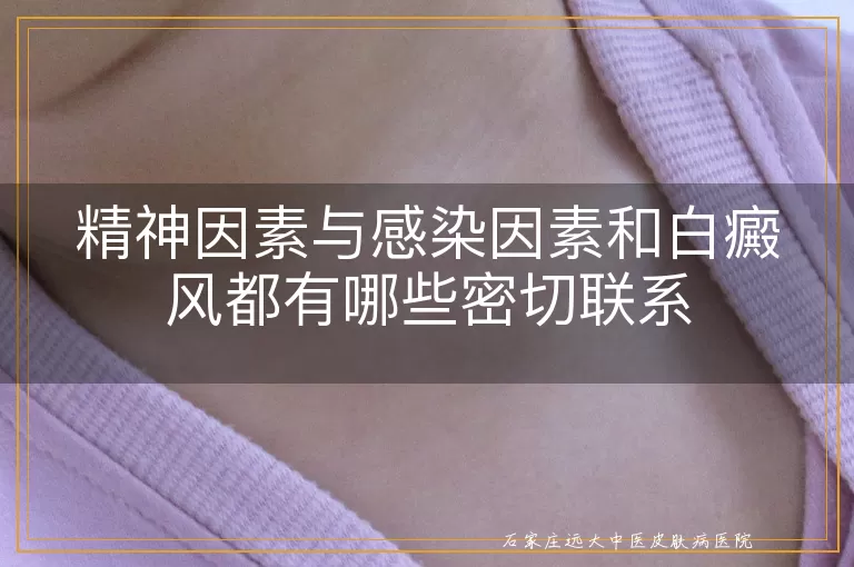 精神因素与感染因素和白癜风都有哪些密切联系