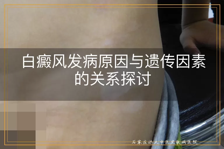 白癜风发病原因与遗传因素的关系探讨