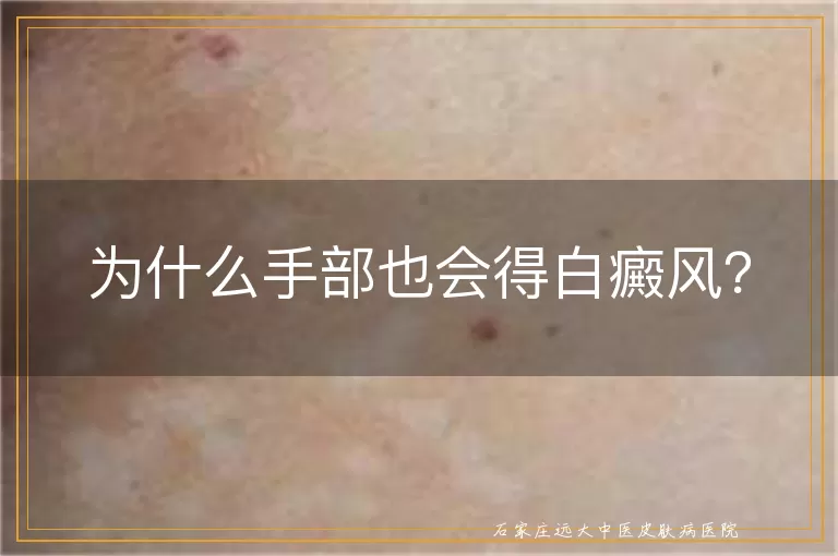为什么手部也会得白癜风？