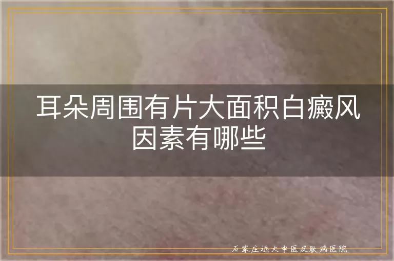 耳朵周围有片大面积白癜风因素有哪些