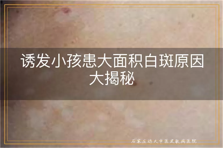 诱发小孩患大面积白斑原因大揭秘