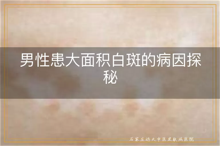 男性患大面积白斑的病因探秘