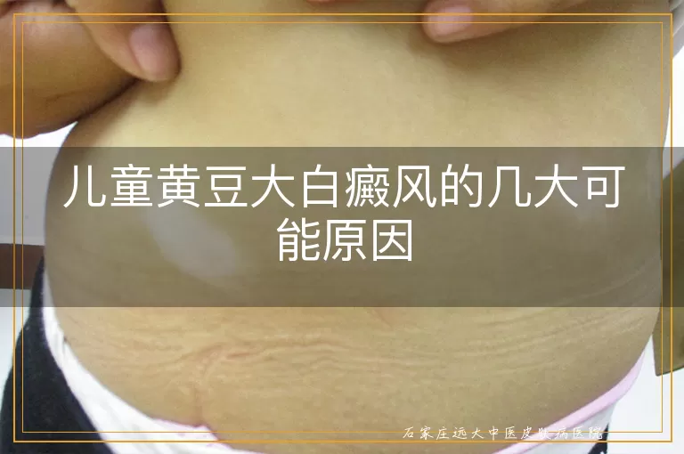 儿童黄豆大白癜风的几大可能原因