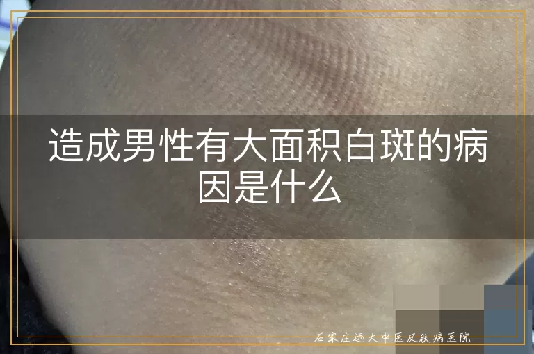 造成男性有大面积白斑的病因是什么