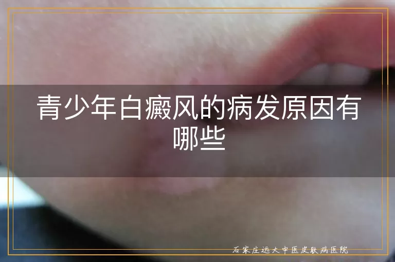 青少年白癜风的病发原因有哪些