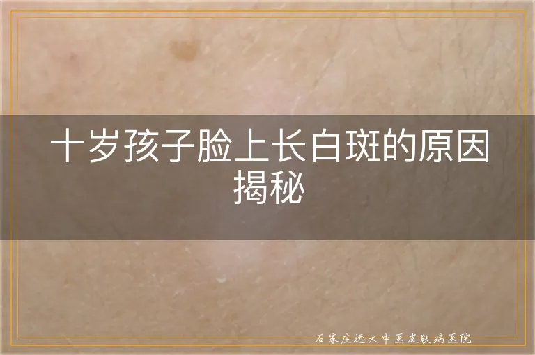 十岁孩子脸上长白斑的原因揭秘