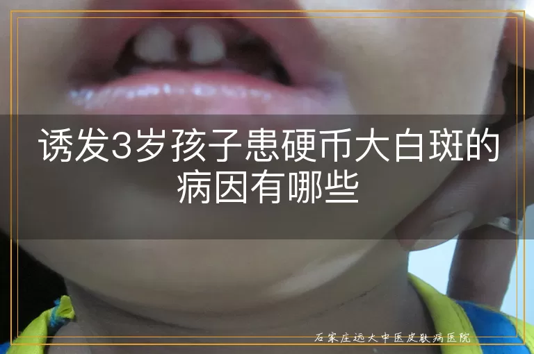 诱发3岁孩子患硬币大白斑的病因有哪些