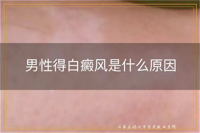 男性得白癜风是什么原因