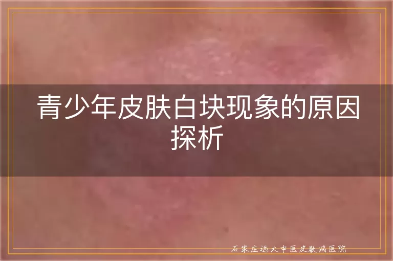 青少年皮肤白块现象的原因探析