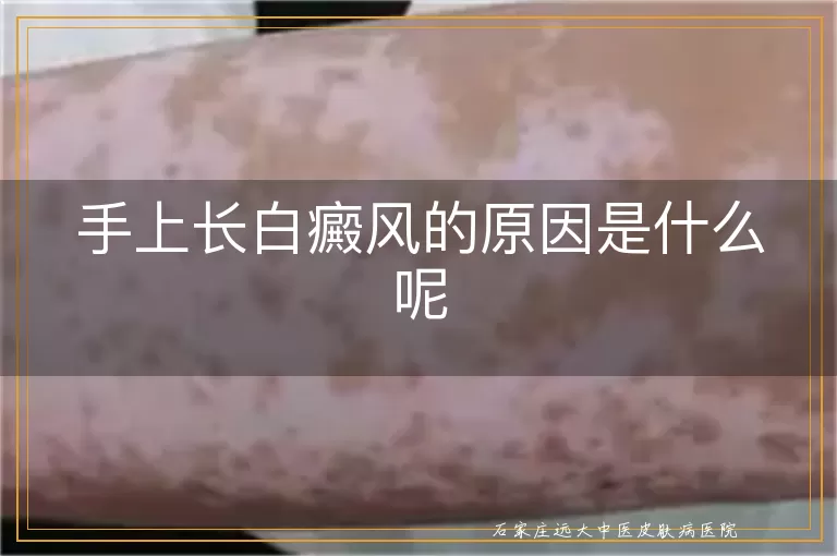 手上长白癜风的原因是什么呢