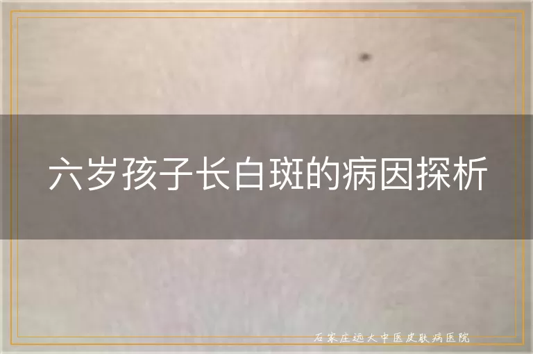 六岁孩子长白斑的病因探析