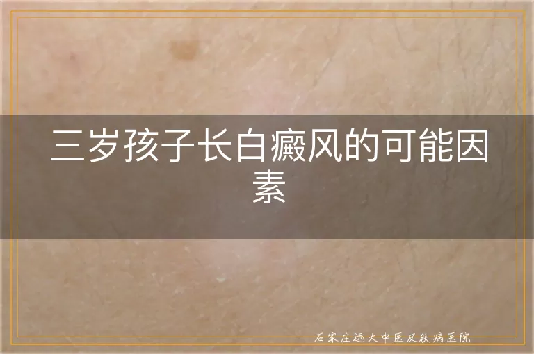 三岁孩子长白癜风的可能因素