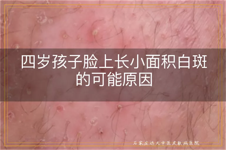 四岁孩子脸上长小面积白斑的可能原因