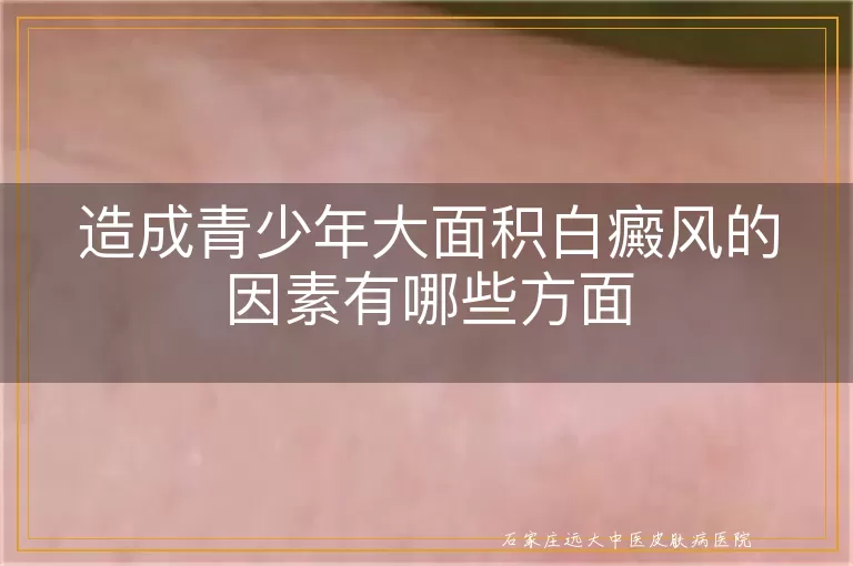 造成青少年大面积白癜风的因素有哪些方面