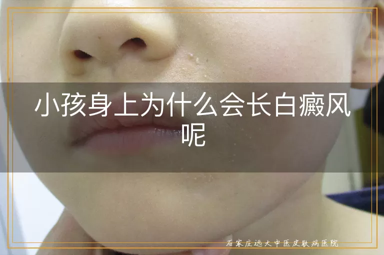 小孩身上为什么会长白癜风呢