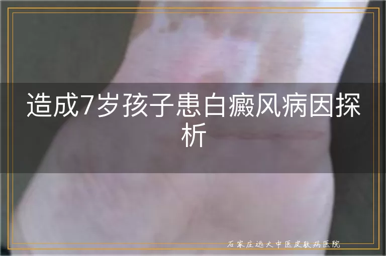 造成7岁孩子患白癜风病因探析