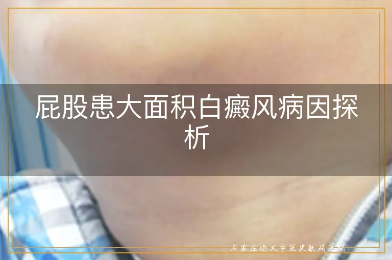 屁股患大面积白癜风病因探析