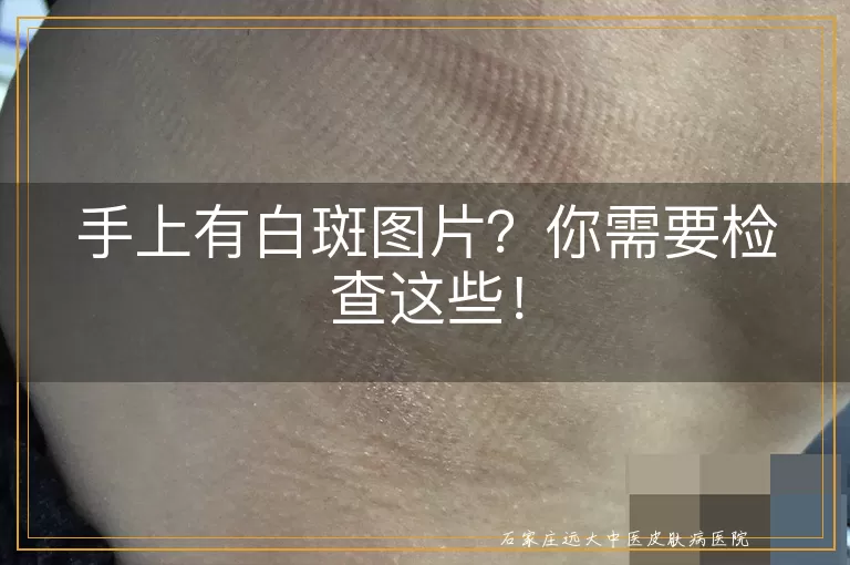 手上有白斑图片？你需要检查这些！