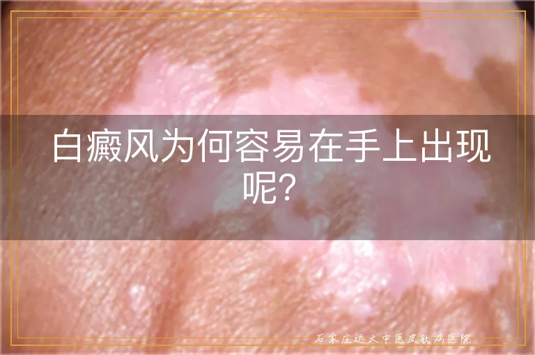 白癜风为何容易在手上出现呢？
