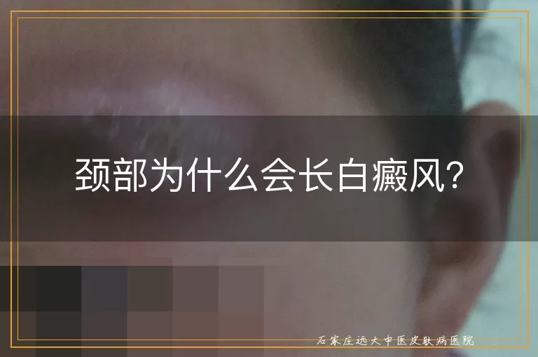 颈部为什么会长白癜风？