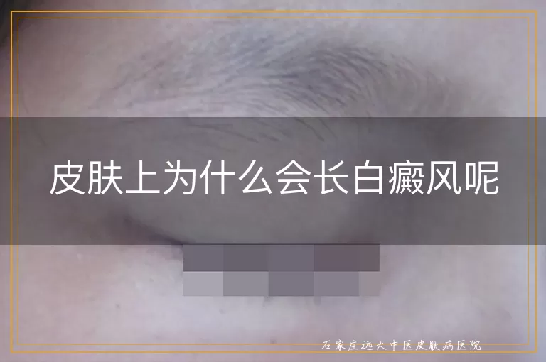 皮肤上为什么会长白癜风呢