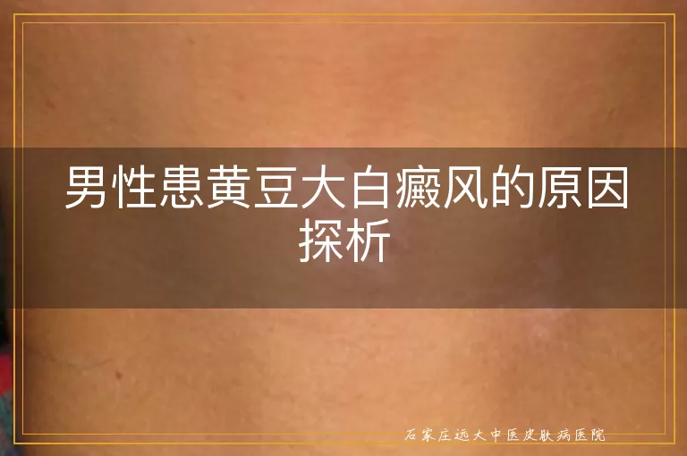 男性患黄豆大白癜风的原因探析