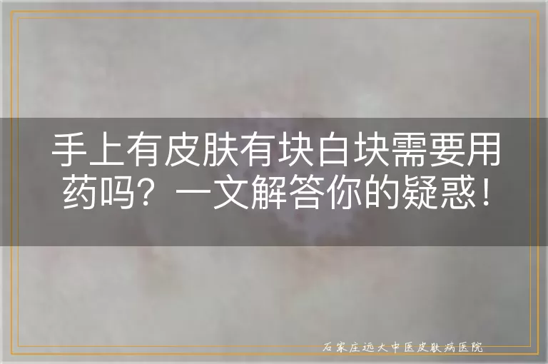 手上有皮肤有块白块需要用药吗？一文解答你的疑惑！