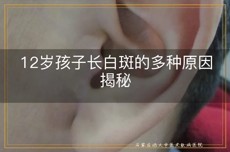 12岁孩子长白斑的多种原因揭秘