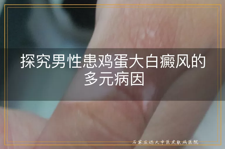 探究男性患鸡蛋大白癜风的多元病因