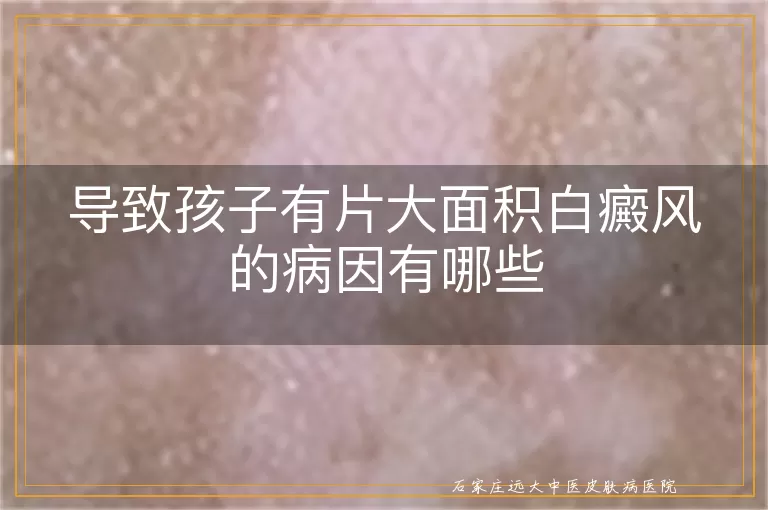 导致孩子有片大面积白癜风的病因有哪些