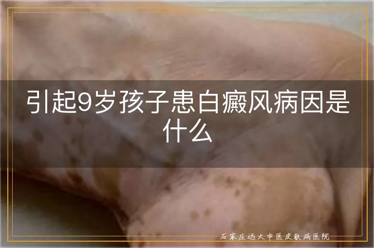 引起9岁孩子患白癜风病因是什么