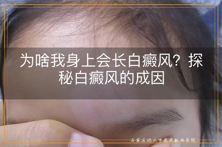 为啥我身上会长白癜风？探秘白癜风的成因