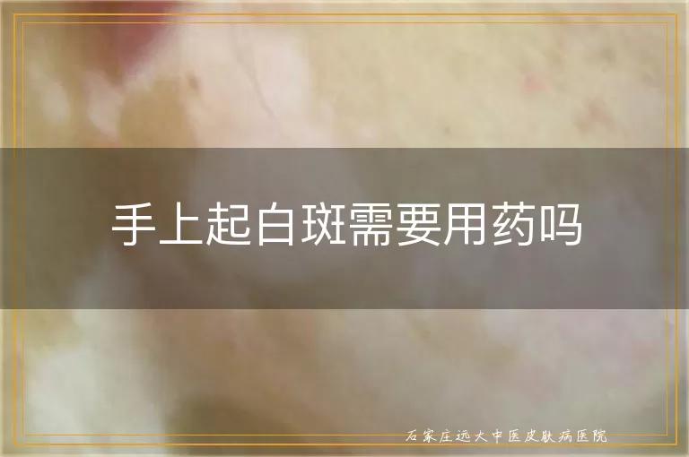 手上起白斑需要用药吗