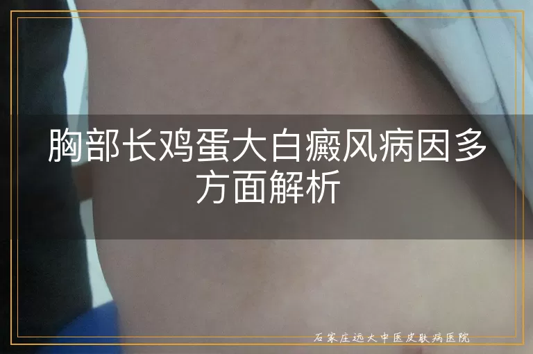胸部长鸡蛋大白癜风病因多方面解析