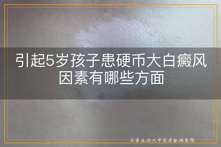 引起5岁孩子患硬币大白癜风因素有哪些方面