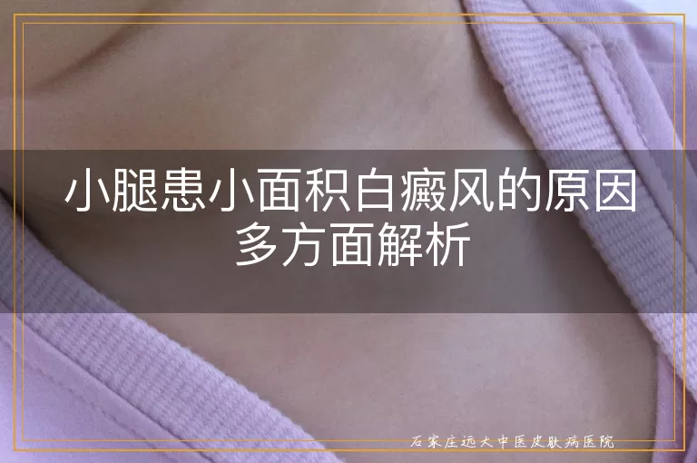 小腿患小面积白癜风的原因多方面解析