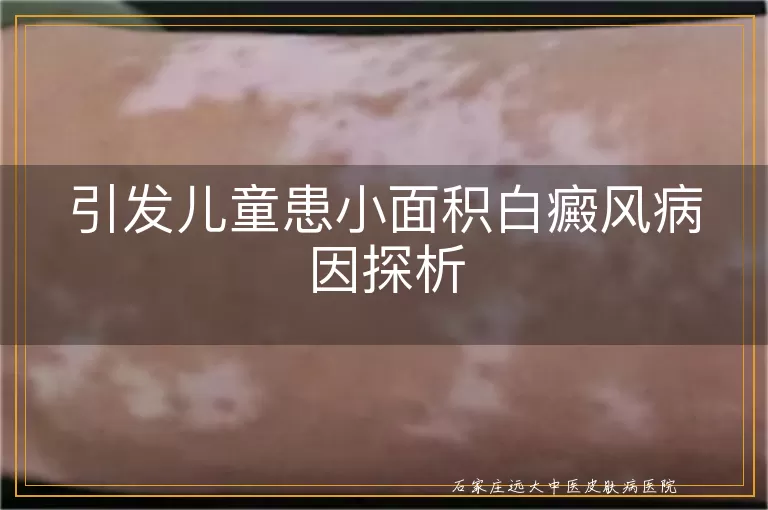 引发儿童患小面积白癜风病因探析