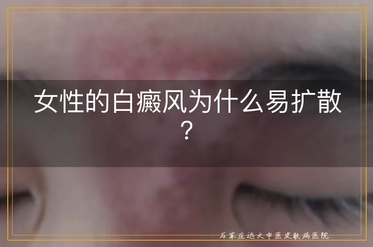 女性的白癜风为什么易扩散？