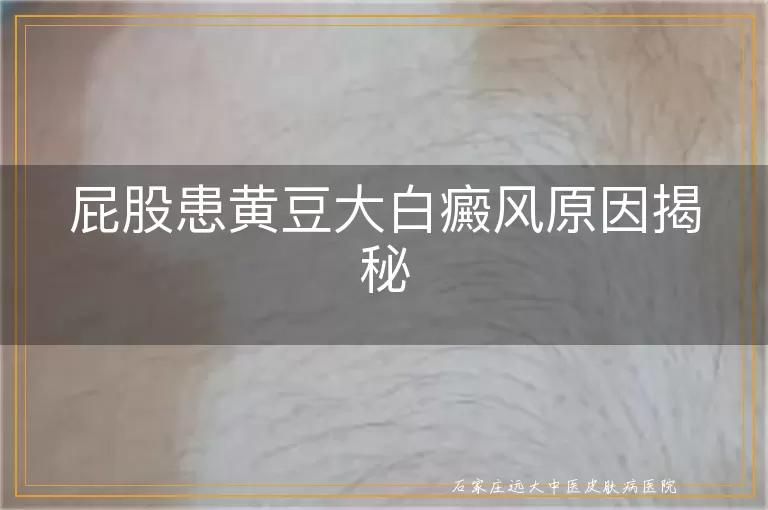 屁股患黄豆大白癜风原因揭秘