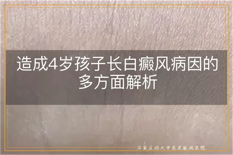 造成4岁孩子长白癜风病因的多方面解析