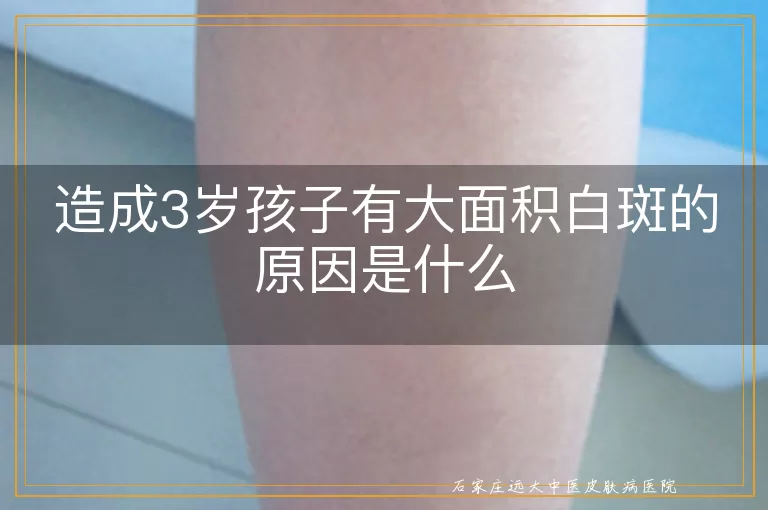 造成3岁孩子有大面积白斑的原因是什么