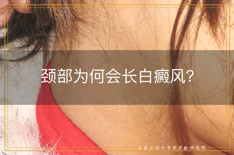 颈部为何会长白癜风？