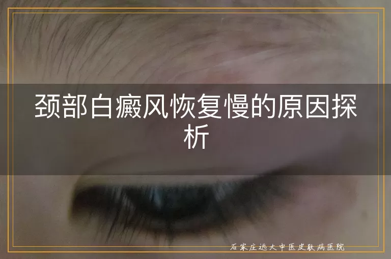 颈部白癜风恢复慢的原因探析