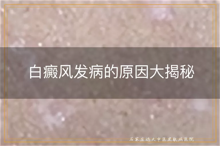 白癜风发病的原因大揭秘
