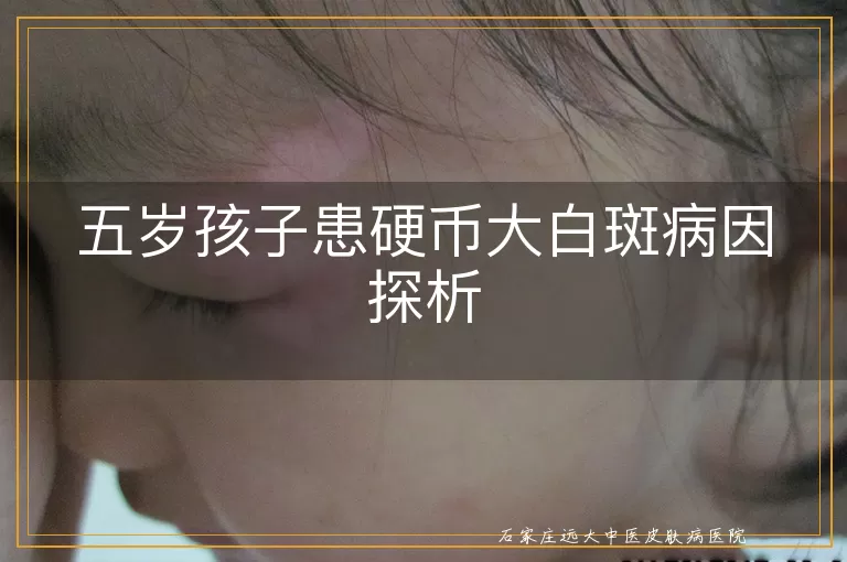 五岁孩子患硬币大白斑病因探析