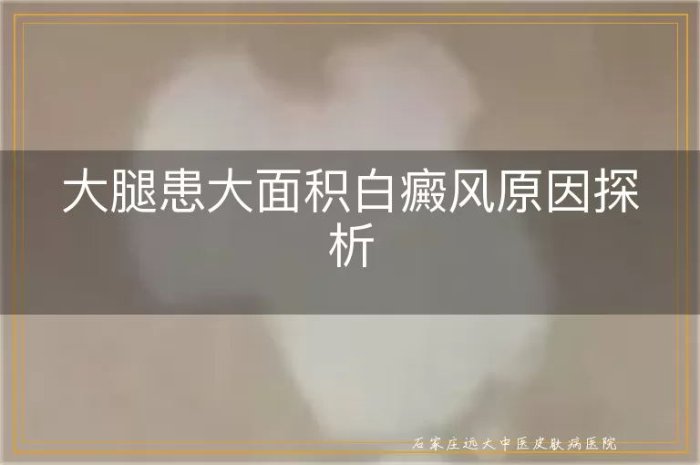 大腿患大面积白癜风原因探析
